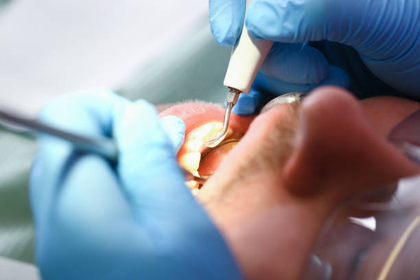 Best Dental Abscess Treatment in Missouri Valley, IA